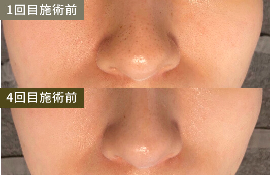 毛穴・黒ずみ(1回目施術前→4回目施術後)