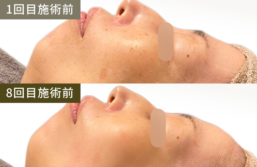 シミ・シワ(1回目施術前→8回目施術後)